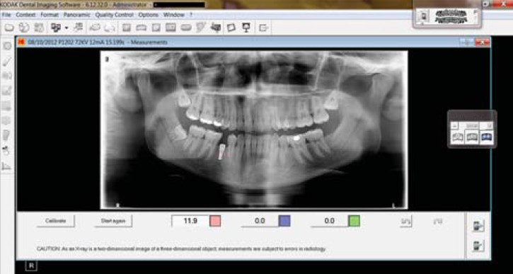 Measurement using a computer software tool to determine the vertical dimension of an implant placed in the lower jaw. The radiograph shows the calculated length between the two points selected by the examiner using the computer's mouse.